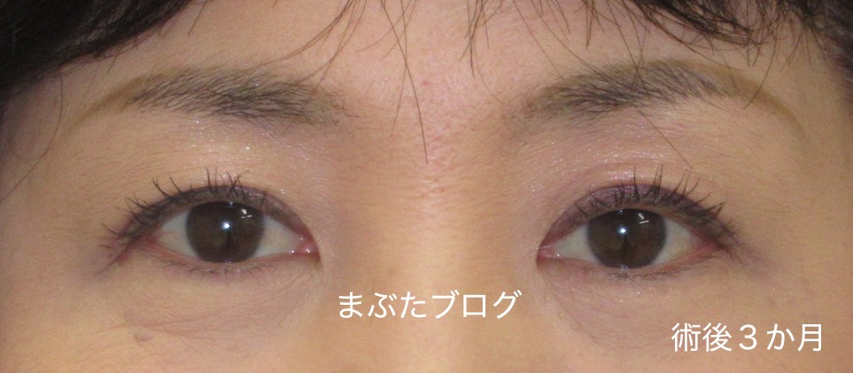 年前の自分に戻す眼瞼下垂症手術 術後経過とダウンタイム 50代女性 続き 王子のまぶたブログ 眼瞼下垂と二重