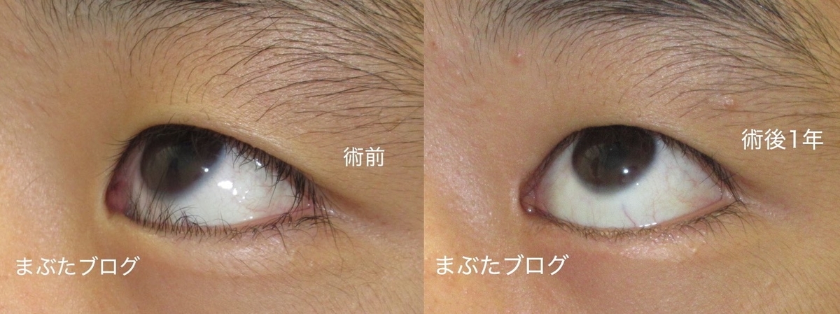 重度の逆さまつ毛をしっかり治す 目頭切開と補助切開の合わせ技 王子のまぶたブログ 眼瞼下垂と二重