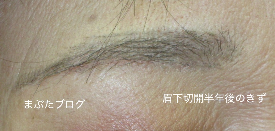 三角目といえば眉下切開 王子のまぶたブログ 眼瞼下垂と二重
