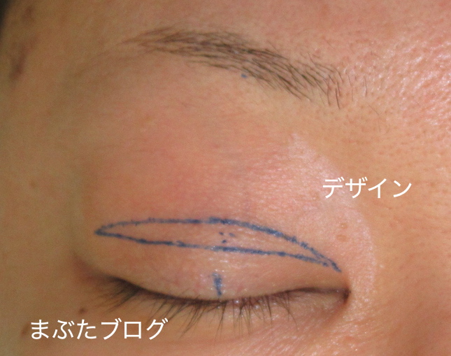 二重幅広めの眼瞼下垂手術 ダウンタイムが長いです 30代女性 王子のまぶたブログ 眼瞼下垂と二重
