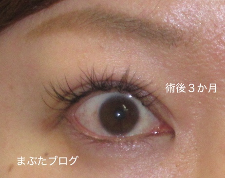 二重幅広めの眼瞼下垂手術 ダウンタイムが長いです 30代女性 王子のまぶたブログ 眼瞼下垂と二重