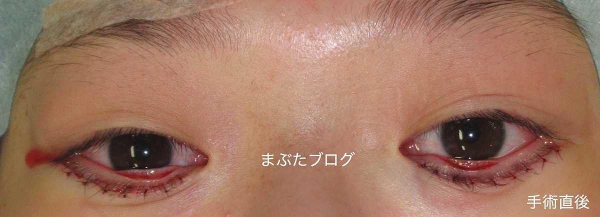 逆さまつげ 目頭だけ