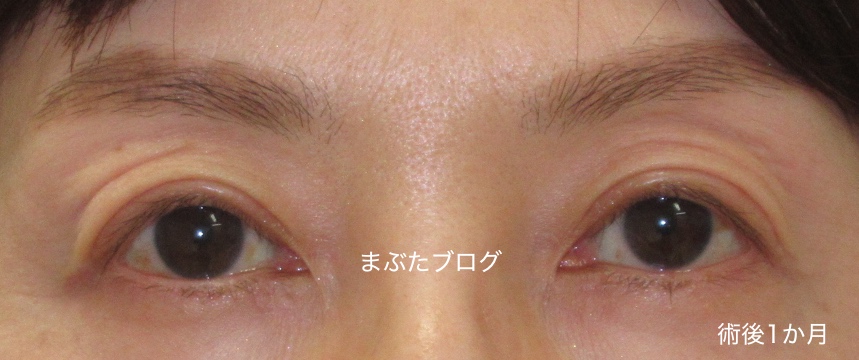 眼瞼下垂修正 幅広二重を狭くする ふんわりとしたつりあげ法 王子のまぶたブログ 眼瞼下垂と二重