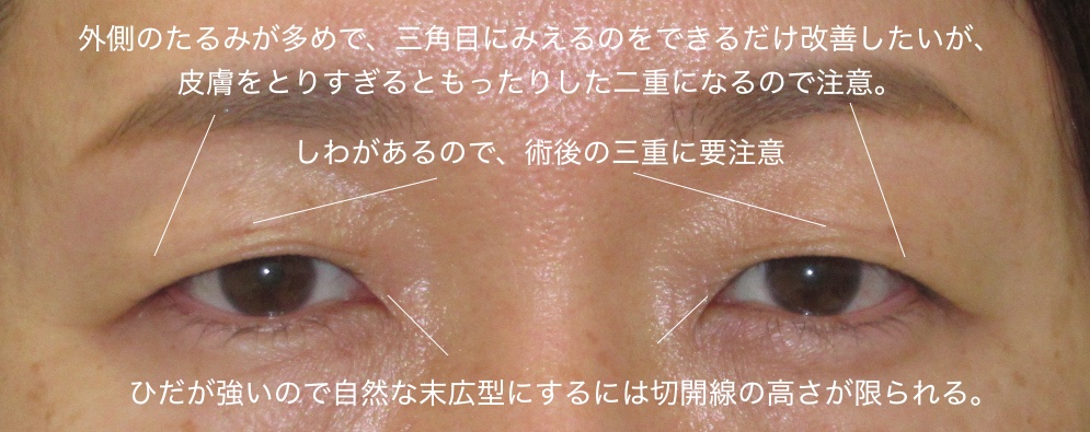 見た目も大切にする眼瞼下垂手術 自然な末広型 直後の左右差 50代女性 王子のまぶたブログ 眼瞼下垂と二重
