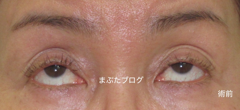 くぼみ目と眠たそうな二重を治す眼瞼下垂手術 50代女性 王子のまぶたブログ 眼瞼下垂と二重