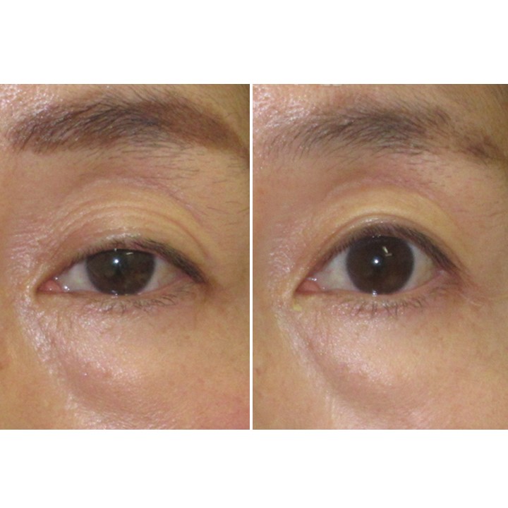 くぼみ目と三重まぶたを治すための眼瞼下垂手術 王子のまぶたブログ 眼瞼下垂と二重