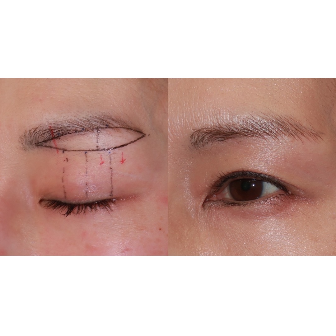 眉下切開で切り取るべきもの 王子のまぶたブログ 眼瞼下垂と二重