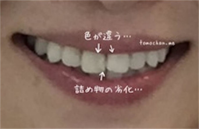 芸能人のような歯になりたくて 前歯4本オールセラミッククラウン治療 矯正 して感じた後悔 メリット デメリット 体験談 ともちゃん Me 芸能人のような歯になりたくて 前歯4本オールセラミッククラウン治療 矯正 して感じた後悔 メリット デメリット 体験談 ともちゃん Me