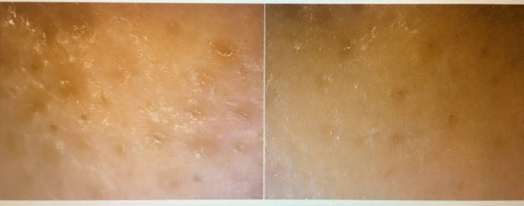 毛穴画像あり 黒ずみ対策 毛穴ケア専門店ポアレスラボレビュー すきあつめろぐ