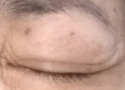 まぶたに出来たイボ２つ