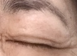 イボを切除した後の様子
