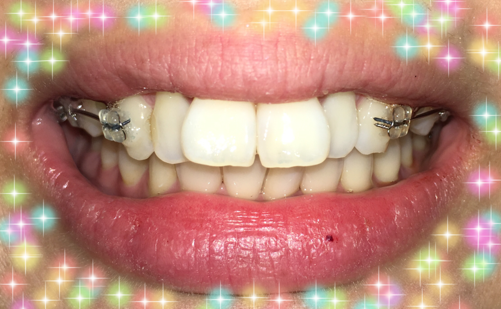 f:id:toothdiary:20170422232149p:plain f:id:toothdiary:20170422232149p:plain