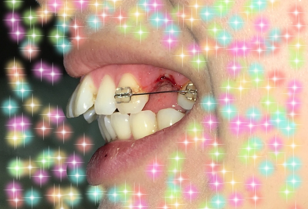 f:id:toothdiary:20170422232558j:plain f:id:toothdiary:20170422232558j:plain