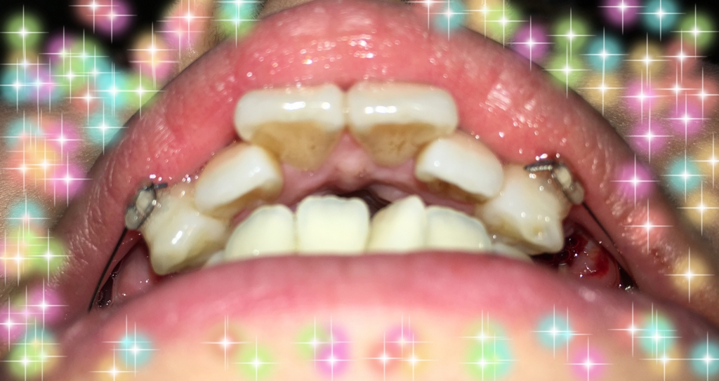 f:id:toothdiary:20170422232617j:plain f:id:toothdiary:20170422232617j:plain