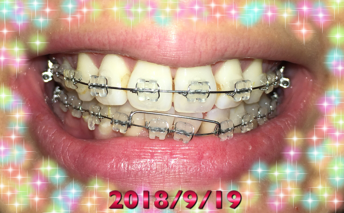 f:id:toothdiary:20190619230744j:plain f:id:toothdiary:20190619230744j:plain