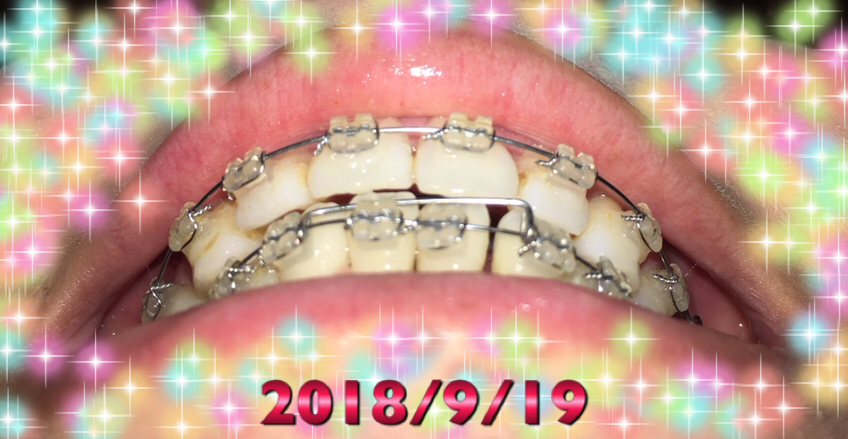 f:id:toothdiary:20190619230819j:plain f:id:toothdiary:20190619230819j:plain
