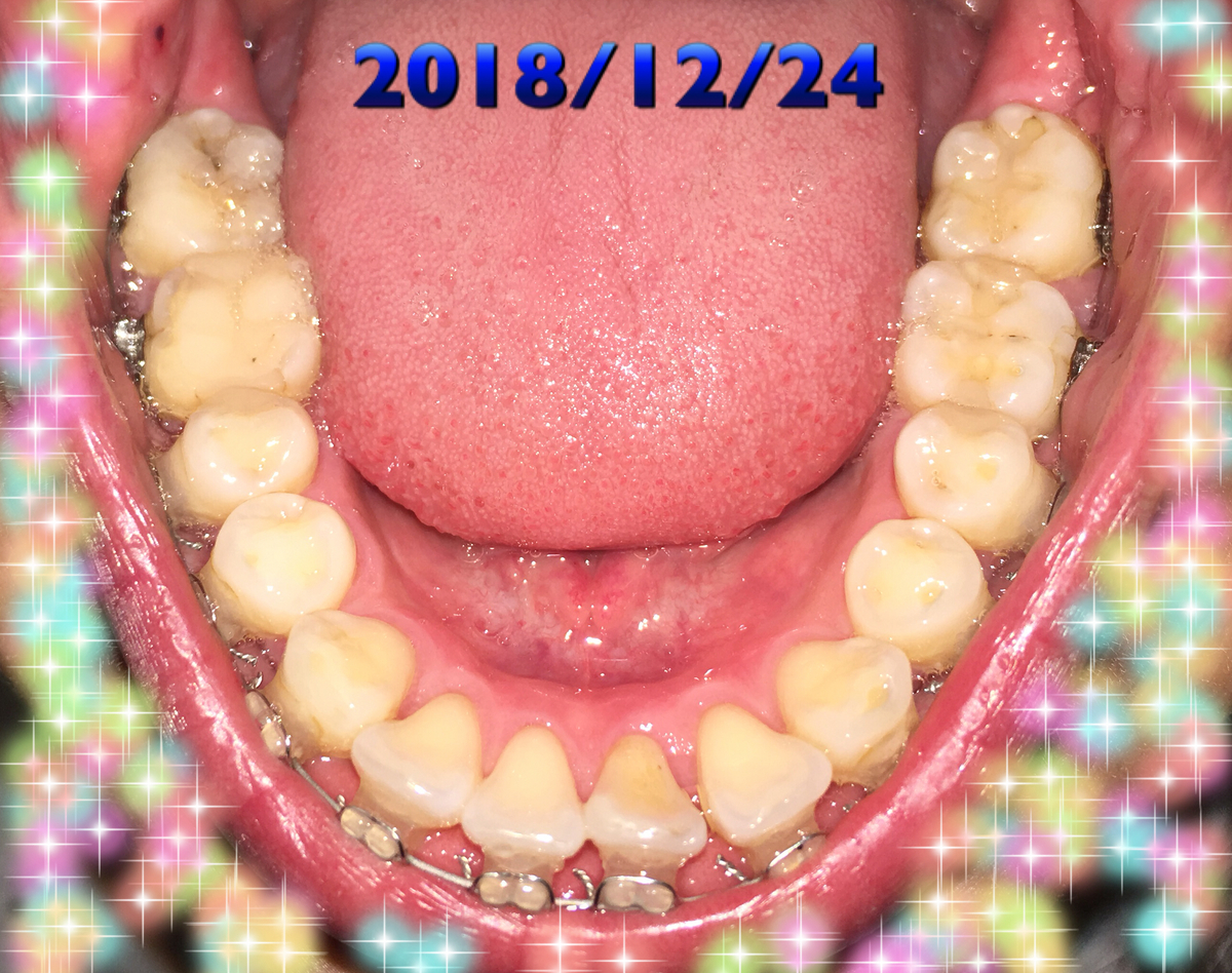 f:id:toothdiary:20190619231025j:plain f:id:toothdiary:20190619231025j:plain