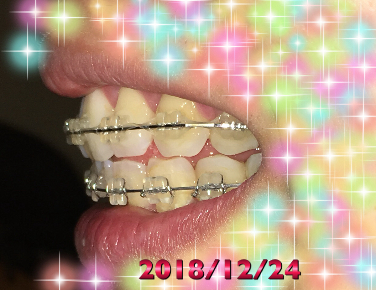 f:id:toothdiary:20190619231044j:plain f:id:toothdiary:20190619231044j:plain