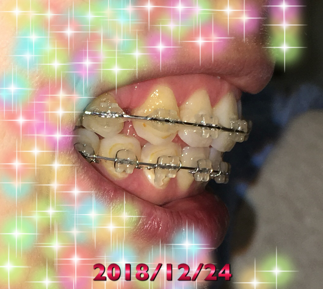 f:id:toothdiary:20190619231100j:plain f:id:toothdiary:20190619231100j:plain