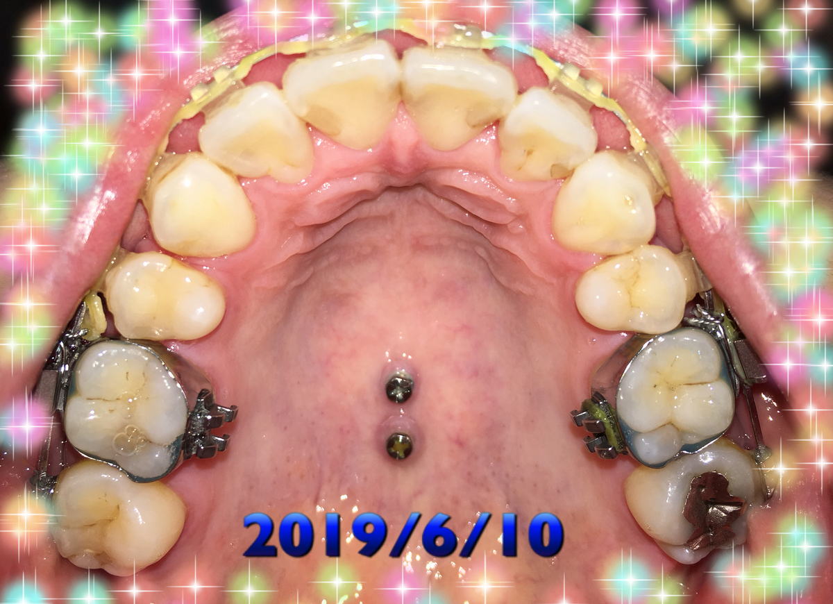 f:id:toothdiary:20190621215124j:plain f:id:toothdiary:20190621215124j:plain