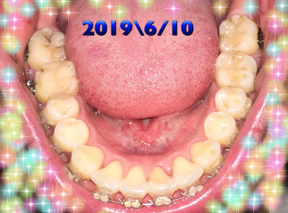 f:id:toothdiary:20190621215145j:plain f:id:toothdiary:20190621215145j:plain