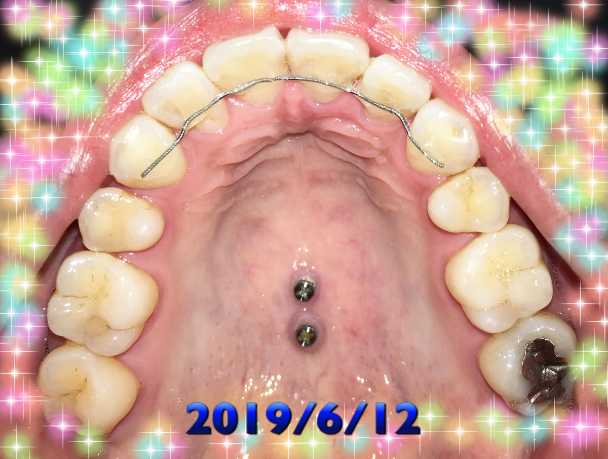 f:id:toothdiary:20190621215203j:plain f:id:toothdiary:20190621215203j:plain