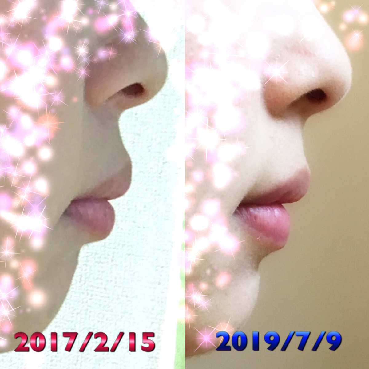 f:id:toothdiary:20190709225641j:plain f:id:toothdiary:20190709225641j:plain