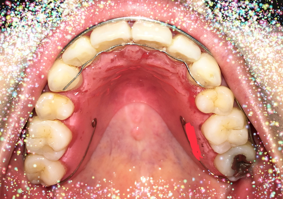 f:id:toothdiary:20200215224359j:plain f:id:toothdiary:20200215224359j:plain