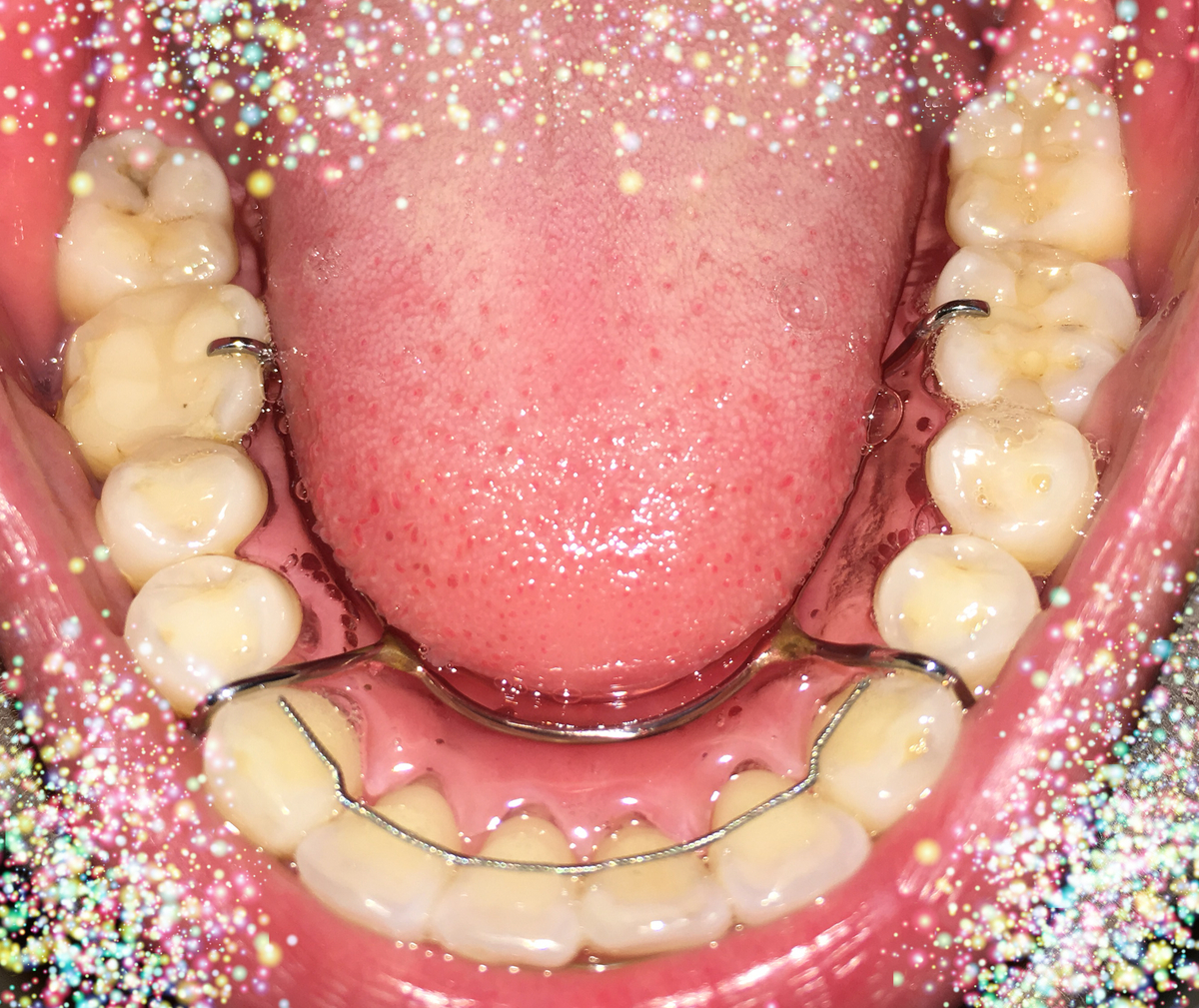 f:id:toothdiary:20200215224425j:plain f:id:toothdiary:20200215224425j:plain