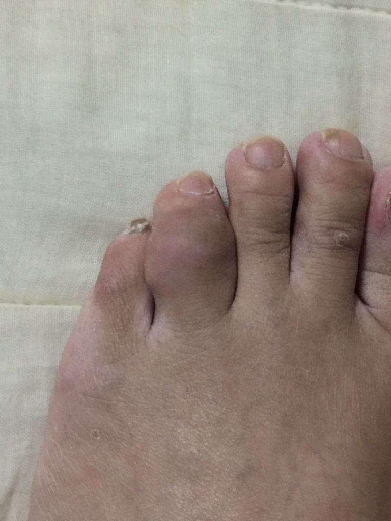 痛風結節 痛風人のお小遣いblog