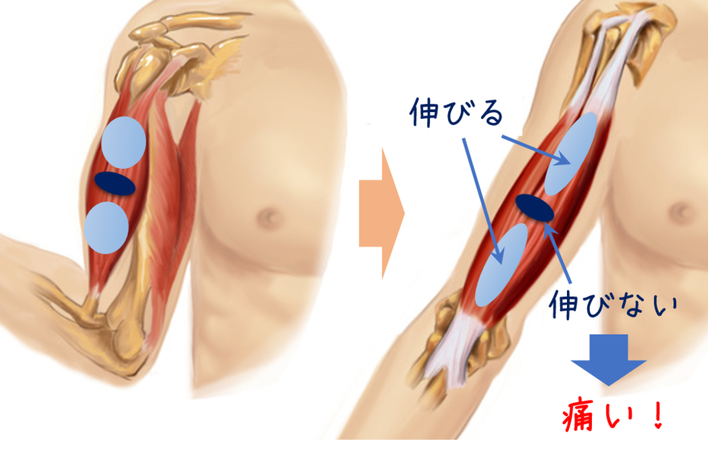 硬い筋肉が柔らかくなる方法 週末に本気を出す療法士