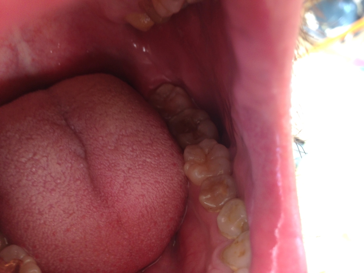 左下の銀歯を外し詰め物を詰めてた状態から詰め物を外した状態