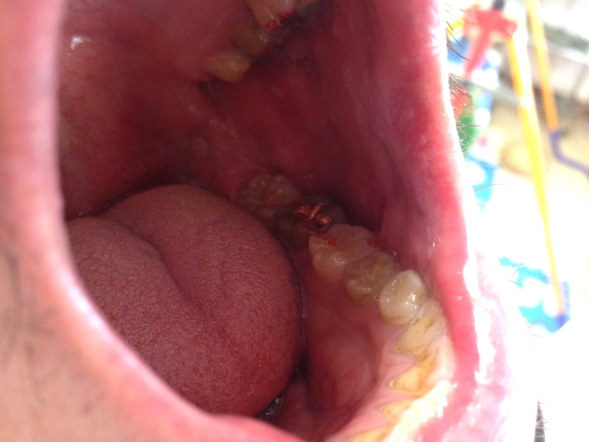 微調整して頂きました2