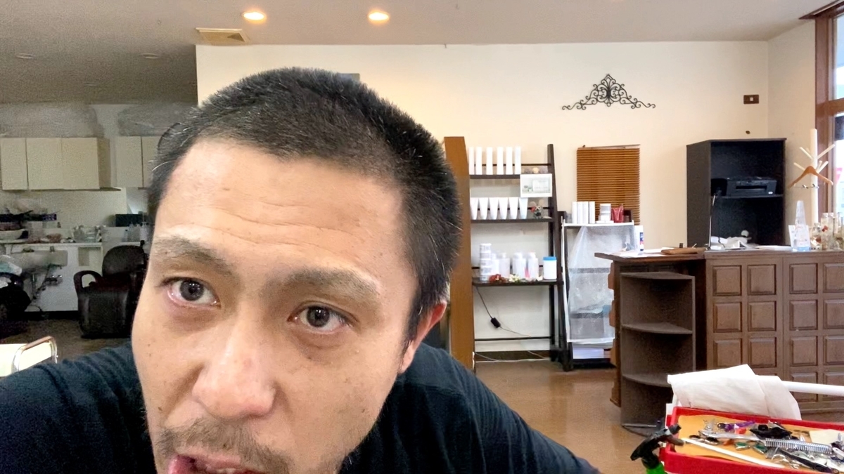 初期段階の薄毛ハゲが15mm坊主に 薄毛ハゲは坊主が似合う Toshiの悪あがき シーズン1