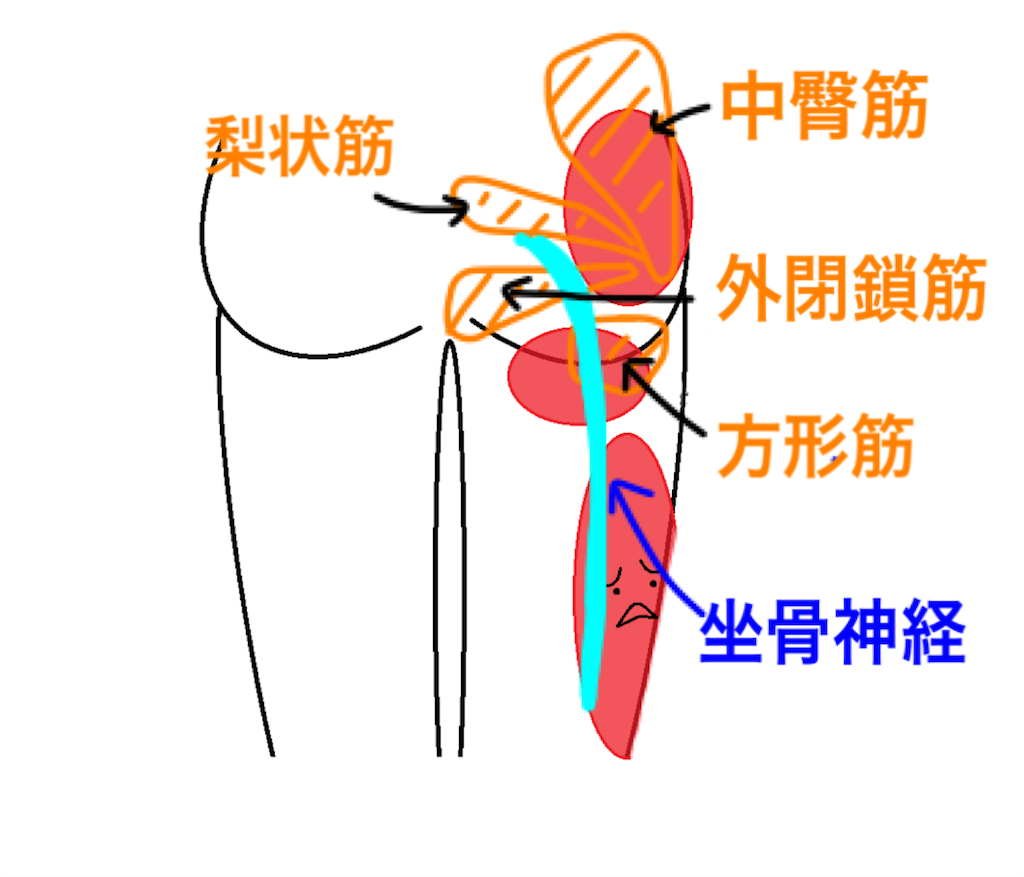 中臀筋と外旋筋に炎症 梨子と坐骨神経痛