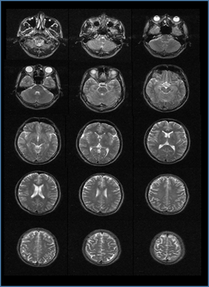 Mriの基礎 脳画像の利用の仕方 For Pt Ot St