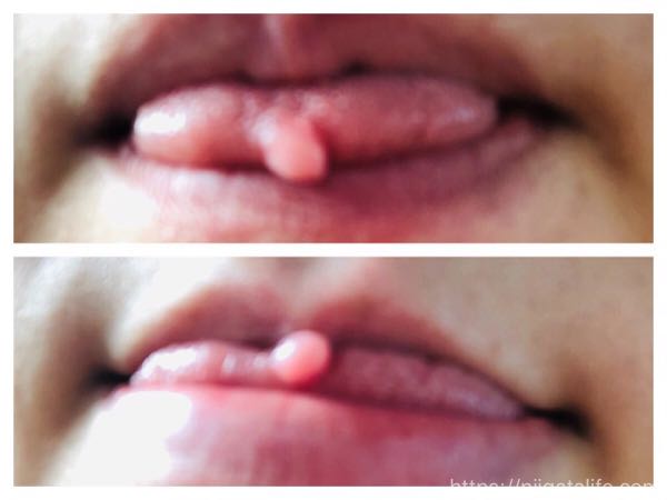 舌先に出来物が…「舌繊維腫」の画像レポを掲載！費用や痛みの経緯など。
