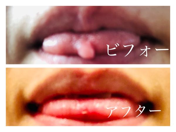 舌先に出来物が…「舌繊維腫」の画像レポを掲載！費用や痛みの経緯など。