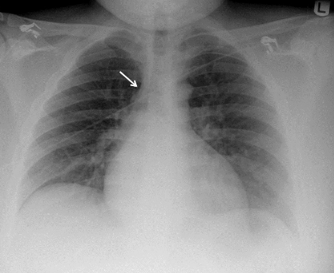 f:id:tsunepi:20160611175216p:plain