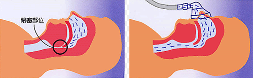 f:id:tsunepi:20161223160245p:plain