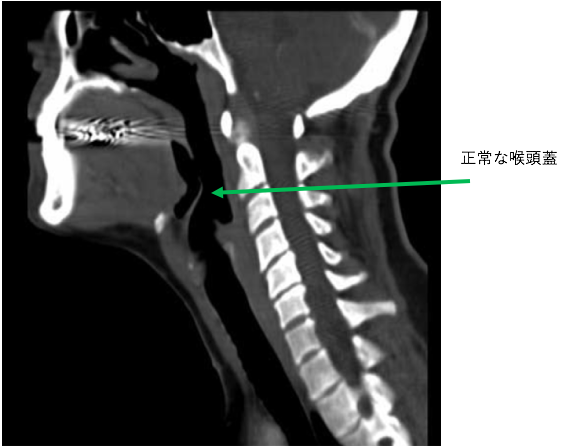 喉頭蓋炎とは何ですか?