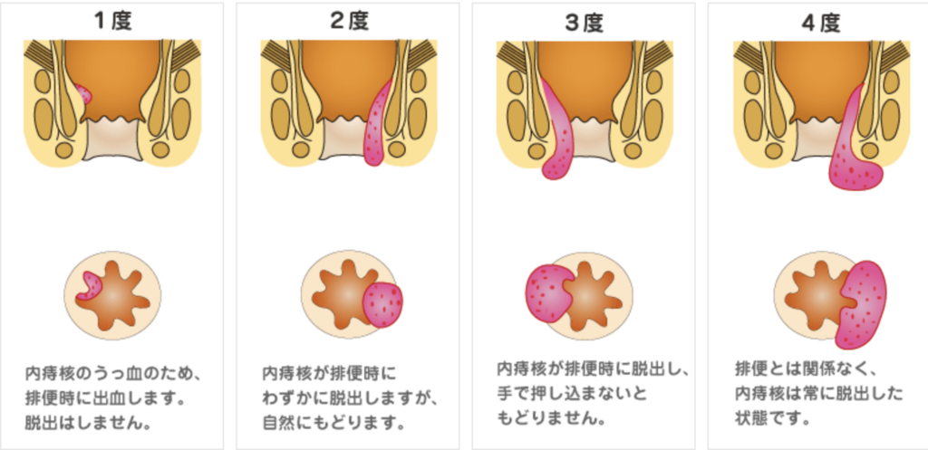 f:id:tsunepi:20180715083702p:plain