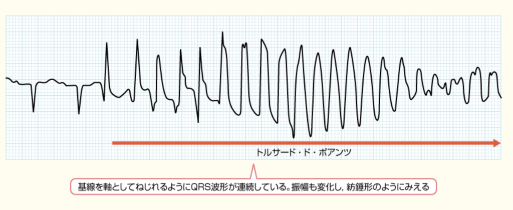 LQTS は平均余命にどのような影響を及ぼしますか?