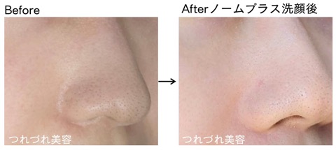 効果は？ノームプラスの洗顔ファインバブルウォッシュを使って