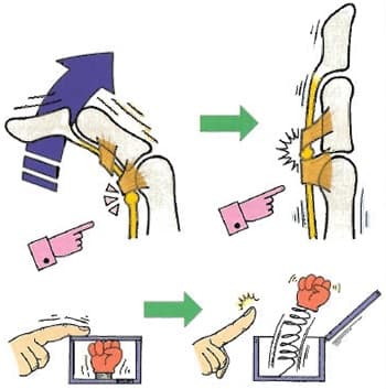 バネ指の症状の絵図