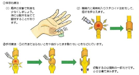 バネ指・弾発指の治療の絵図