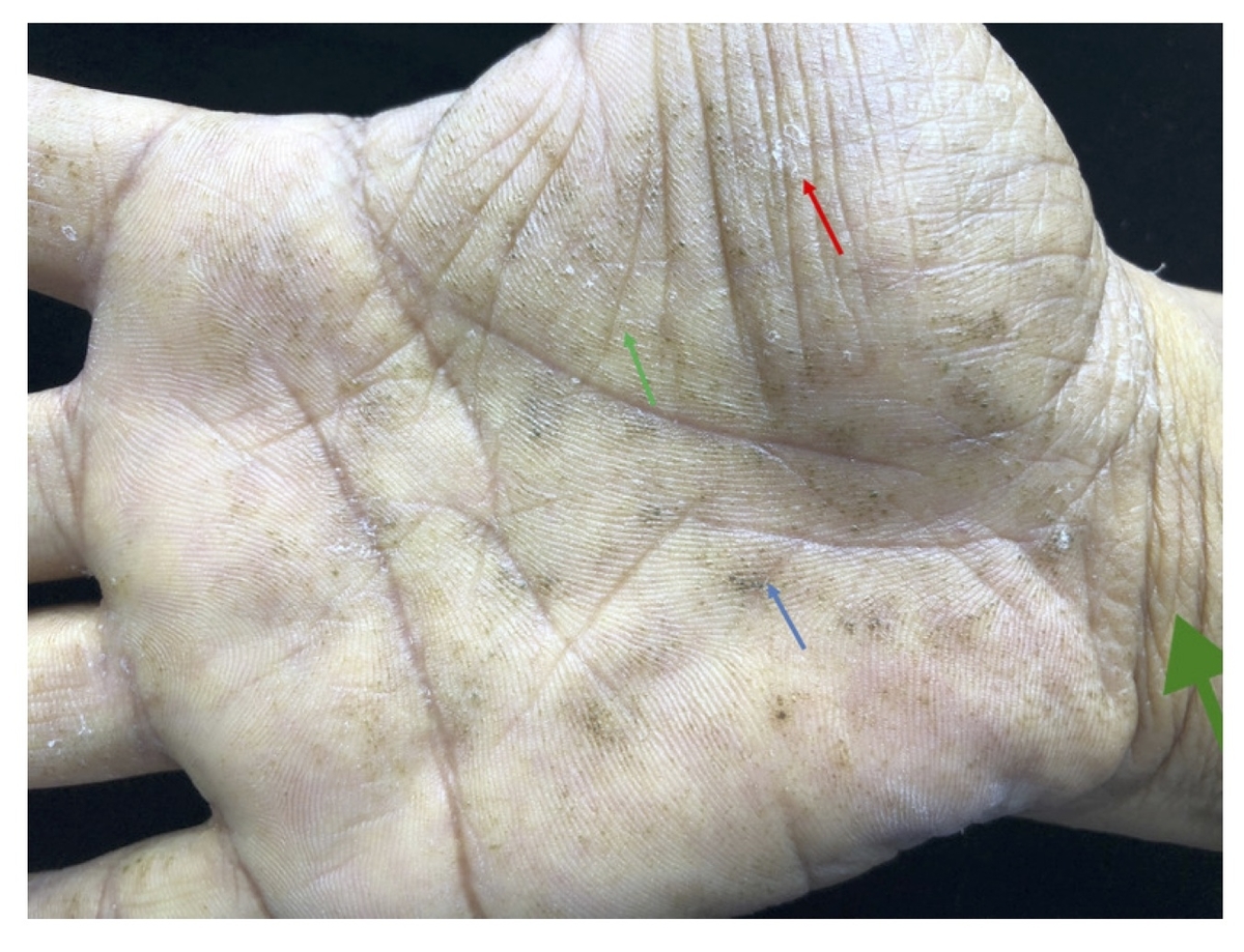 症例 Bmj 37歳男性 手が汚い 栃木県の総合内科医のブログ