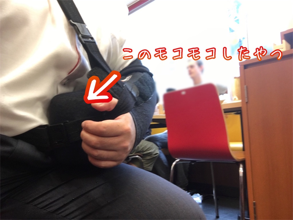 反復性肩関節脱臼の根治に向け手術します ワンゲル部の記録長さん 反復性肩関節脱臼の根治に向け手術します ワンゲル部の記録長さん