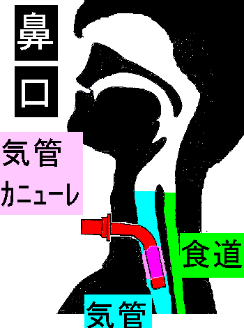 【こんな夜更けにバナナかよ】呼吸を機械に任せる男(人工呼吸器と気管切開の話)002