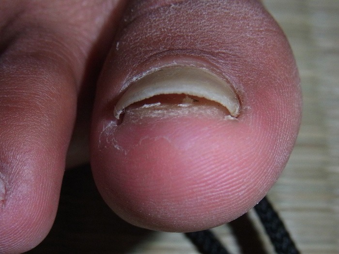 生爪記念日 2012 0603 なまづめ 金太郎が行くよ 生爪記念日 2012 0603 なまづめ 金太郎が行くよ